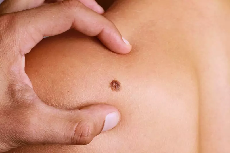 Câncer de Pele: Como Identificar os Sinais e se Proteger