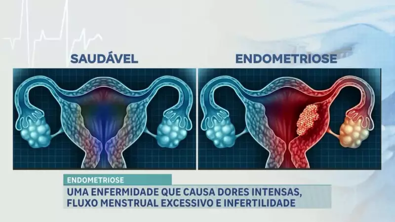 Endometriose: como a doença afeta a vida das mulheres e o que fazer para enfrentá-la