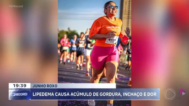 Beatriz supera lipedema e transforma vida com alimentação saudável e esportes