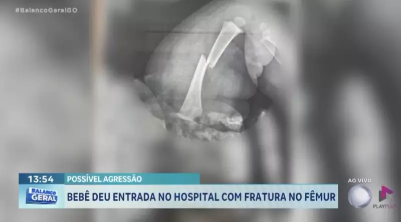 Bebê de 3 meses sofre fratura no fêmur em possível caso de agressão em Goiás