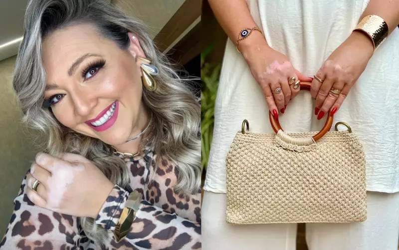 Blogueira com vitiligo transforma vivência em inspiração: 'Não me afeta mais'
