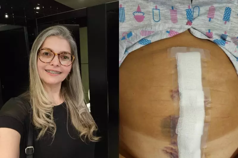 Brasileira descobre tumor raro de 20 cm sem sintomas na Irlanda e busca ajuda