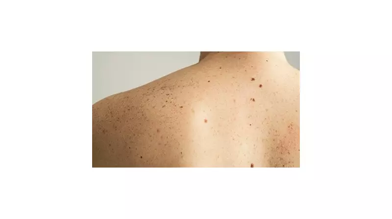 Câncer de Pele Não Melanoma: Prevenção e Diagnóstico Precoce Salvam Vidas