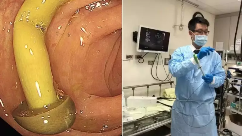 Caso raro: médico descobre cogumelo crescendo no intestino de paciente
