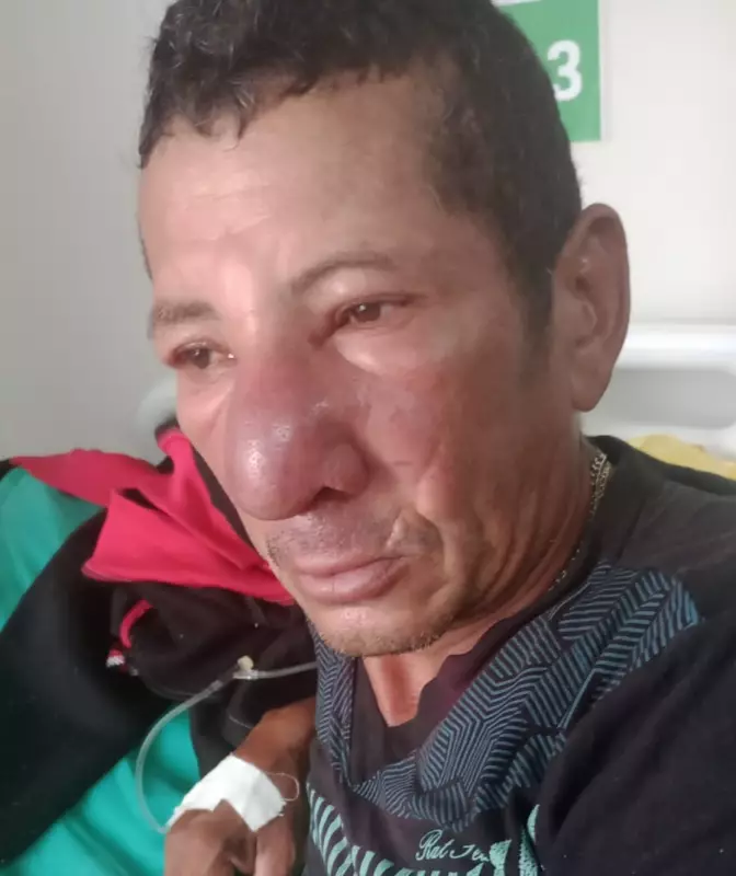 Diarista descobre larvas no nariz após esperar três dias por atendimento no Acre