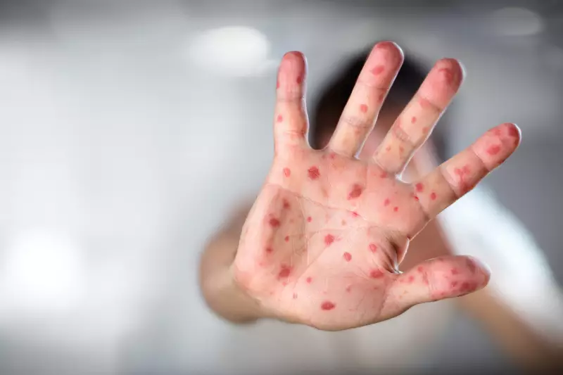 Dose zero contra sarampo: entenda a nova recomendação para bebês no Brasil