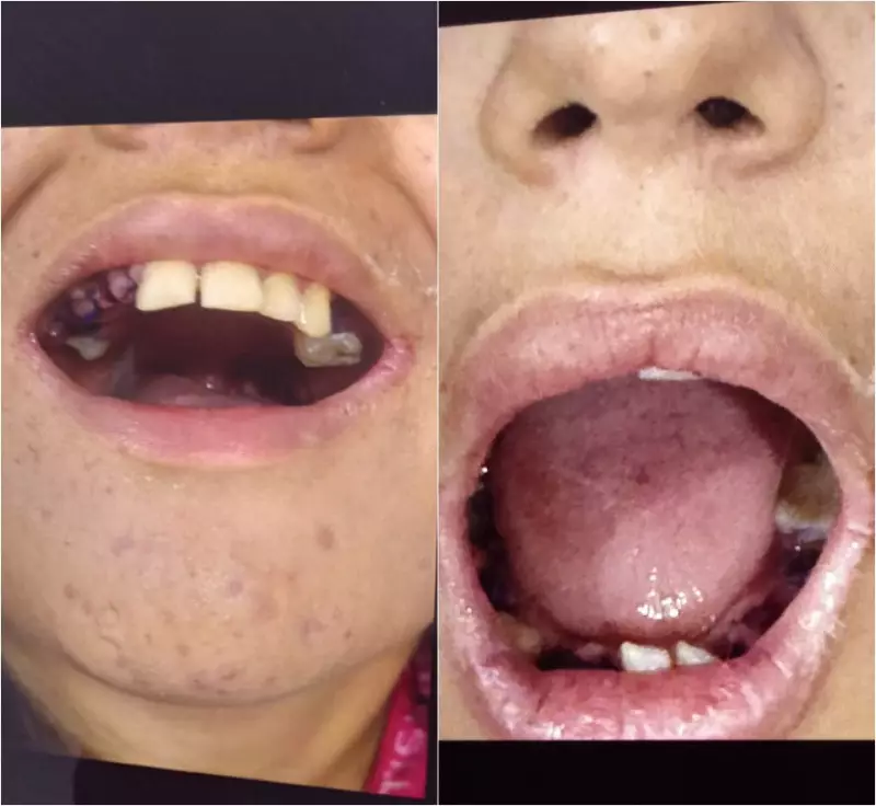 Erro médico? Adolescente com autismo tem 17 dentes arrancados em Belém durante procedimento de restauração
