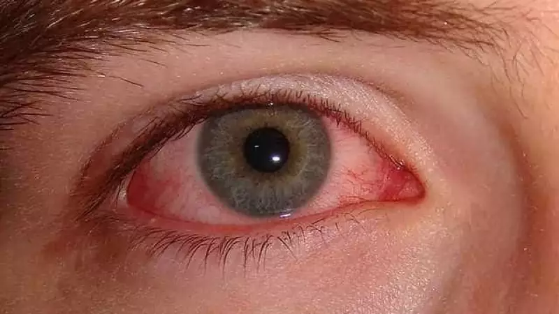 Gripe e resfriado: surto de conjuntivite preocupa especialistas