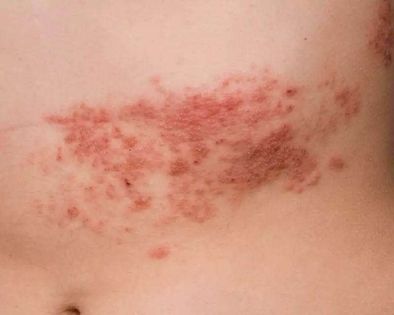 Herpes Zóster: Causas, Sintomas e Tratamento para Aliviar a Dor