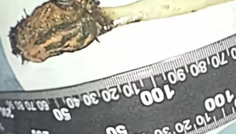 Homem descobre escova de dente engolida na infância presa no intestino há 52 anos — Caso raro choca médicos
