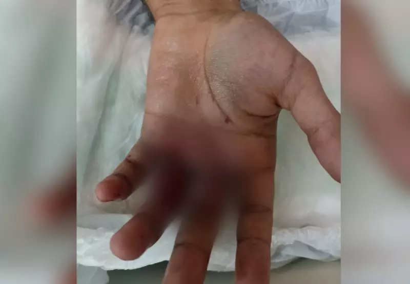 Jovem se fere gravemente após bolo explodir em suas mãos durante festa de aniversário
