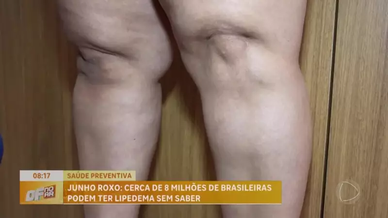 Junho Roxo: 8 milhões de brasileiras podem ter lipedema sem saber - Entenda os sintomas