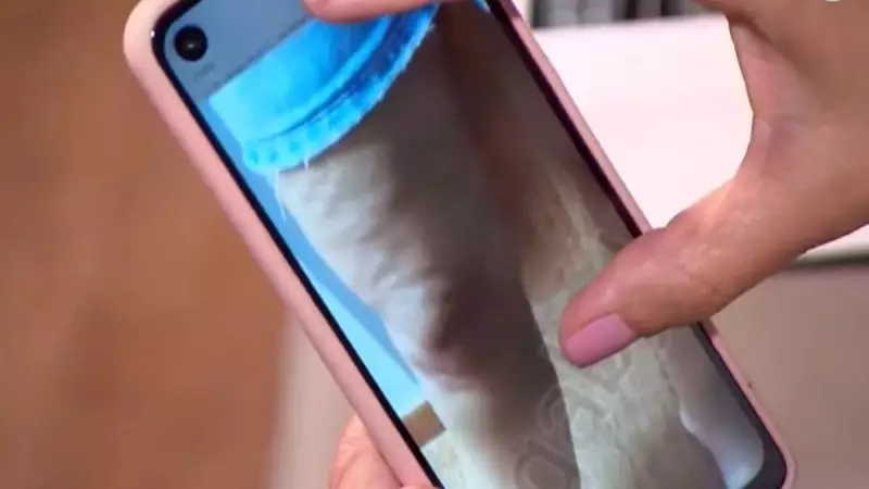 Lipedema: desafios, tratamentos e como identificar essa condição que afeta milhares de mulheres