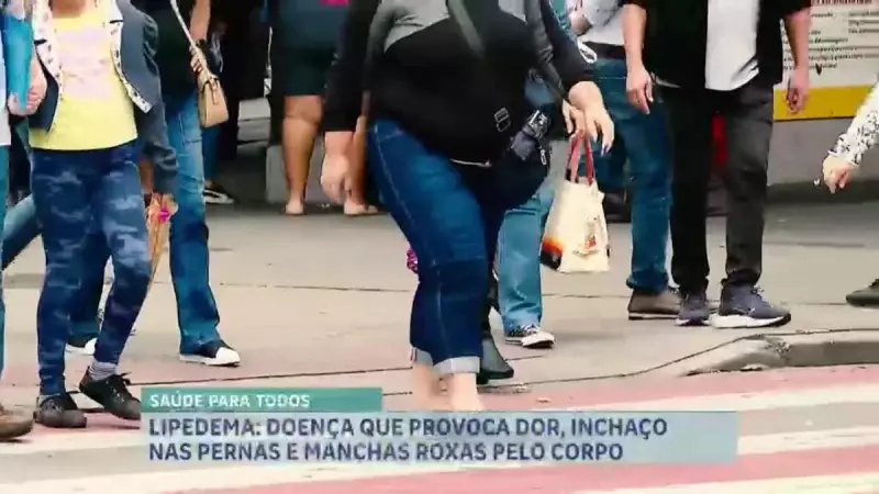 Lipedema: doença que afeta milhões de brasileiras ainda é pouco conhecida