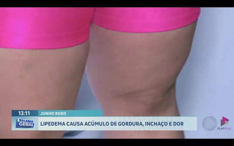 Lipedema: entenda a doença que causa acúmulo de gordura, inchaço e dor