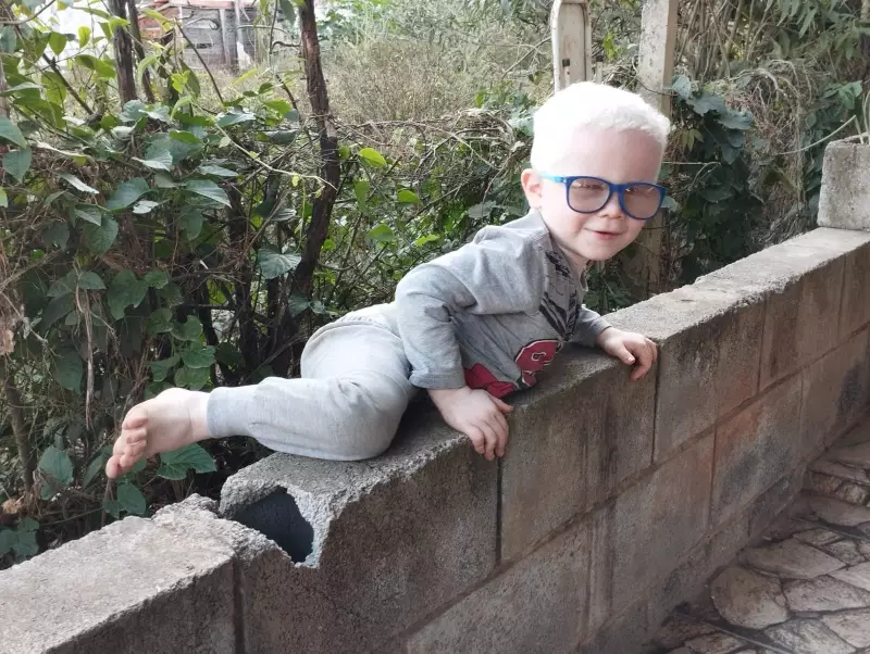 Mãe de filho albino relata dificuldades com falta de protetores solares gratuitos e medicamentos contínuos