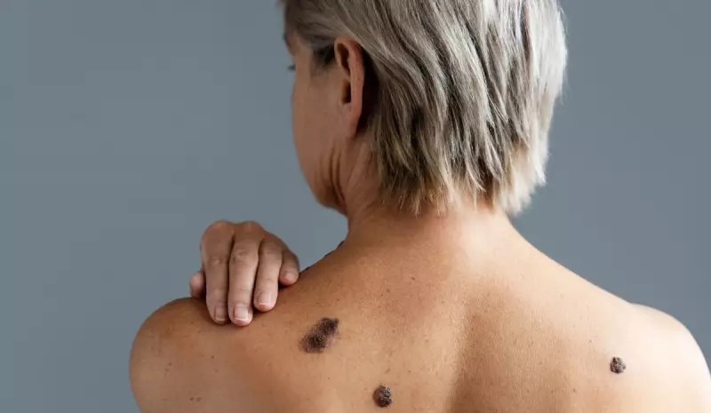 Melanoma: Como Identificar Sinais de Câncer de Pele e Proteger Sua Saúde