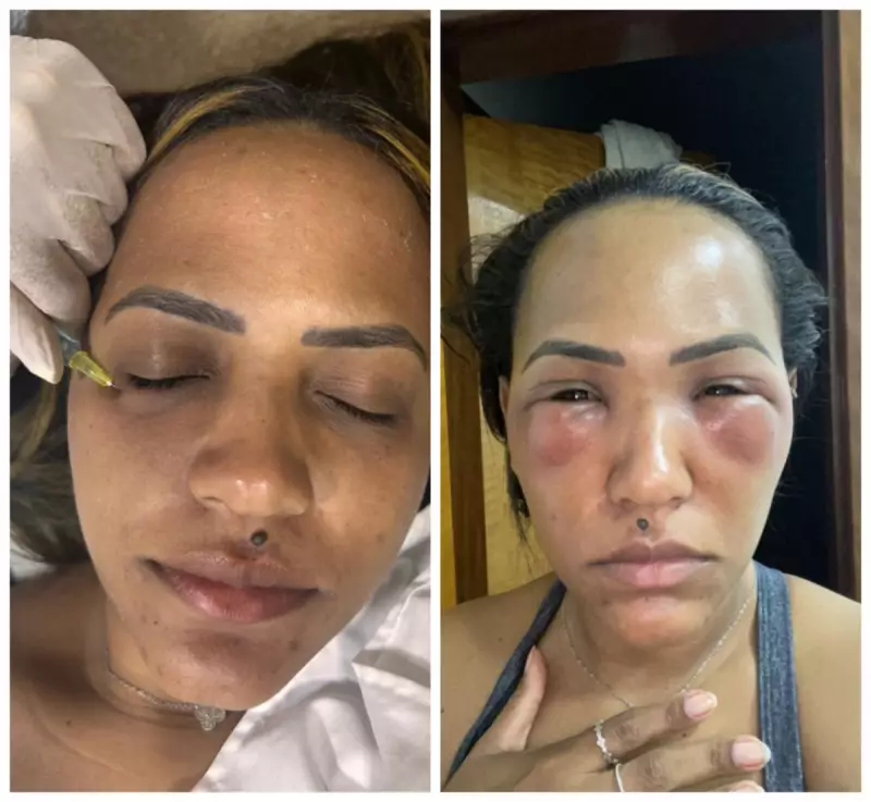 Mulher sofre reação grave após preenchimento de olheiras: "Desejo de melhorar autoestima virou pesadelo"
