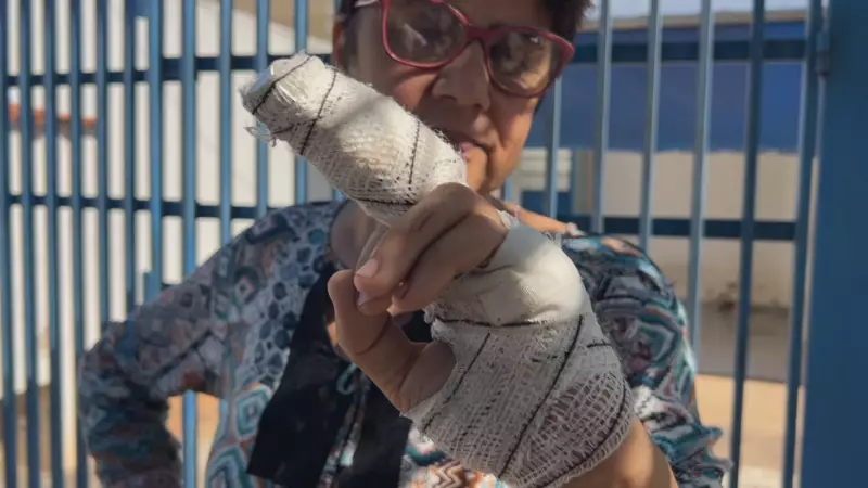 Mulher tem parte do dedo decepado após ataque de pitbull em Marília: entenda o caso