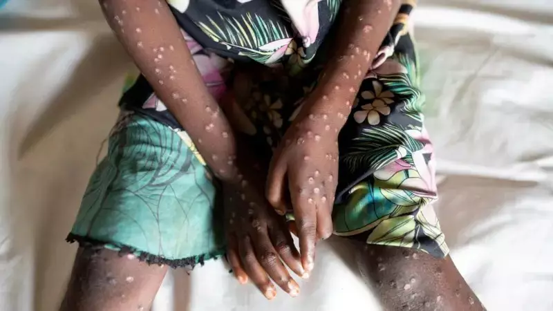 Parintins não registra casos de mpox: paciente já tratava a doença em Manaus, confirma FVS