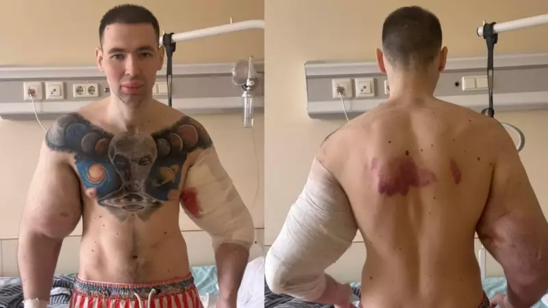 ‘Popeye russo’ decide remover substâncias dos braços após anos de exageros estéticos