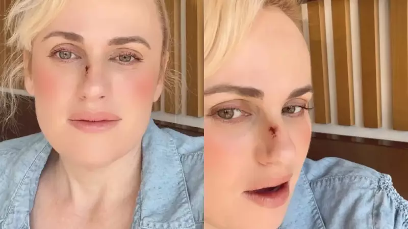 Rebel Wilson sofre acidente grave nas filmagens de 'Bride Hard' e passa por cirurgia
