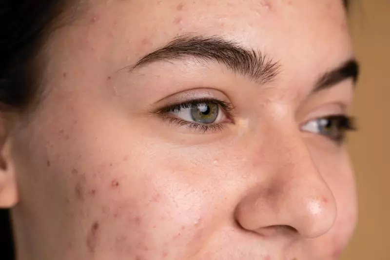Roacutan para acne: entenda as restrições e riscos do remédio usado por Ana Castela