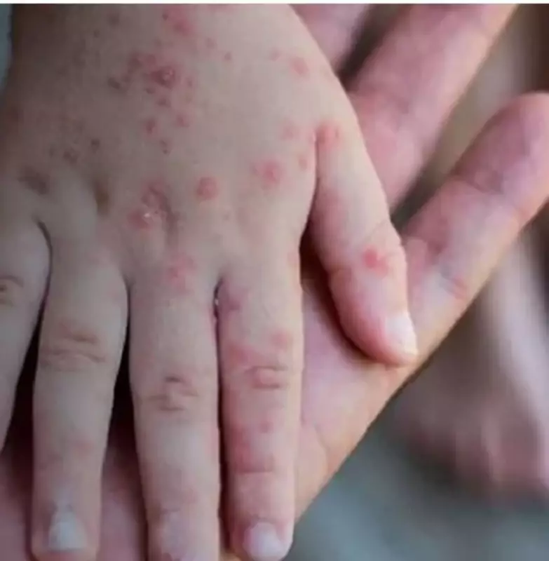 Sete Lagoas em alerta: dois casos suspeitos de varíola dos macacos (mpox) são registrados