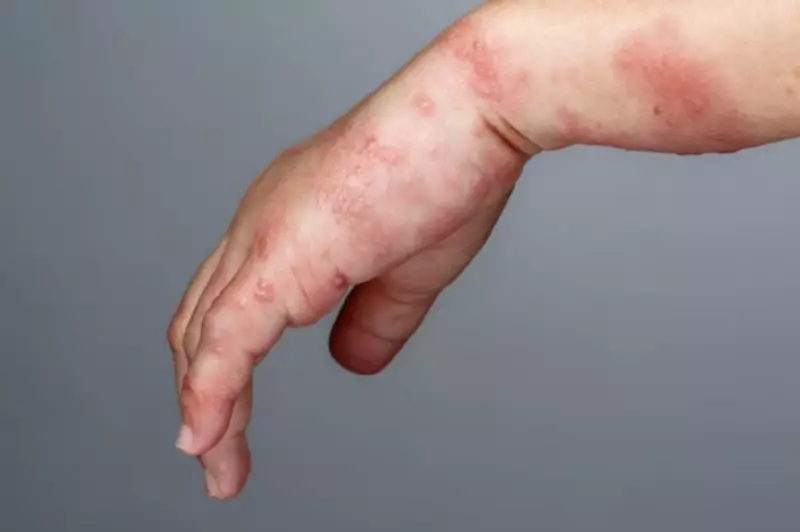 Sporotrichosis: Fungal Disease Raises Alarm in Itajaí – Symptoms and Prevention