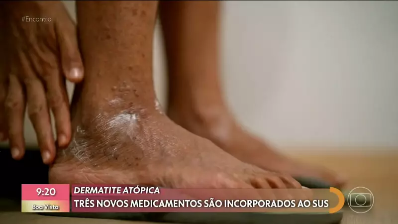 SUS agora oferece novos medicamentos para dermatite atópica: alívio para coceira, inflamação e machucados