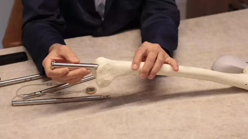 Alongamento ósseo: cirurgia com haste eletrônica faz perna crescer até 8 cm | Inovação médica