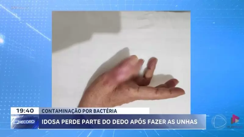 Aposentada tem dedo amputado após procedimento em salão de beleza — o que deu errado?