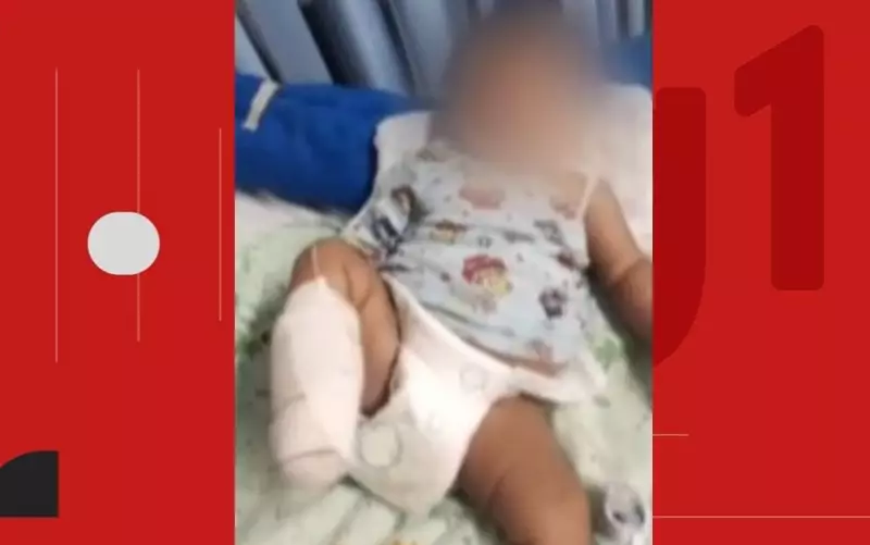 Bebê de 2 meses tem pé amputado após acidente na Bahia: entenda o caso