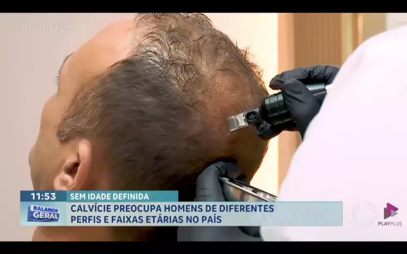 Calvície no Brasil: 42 milhões de homens enfrentam queda de cabelo e impacto na autoestima