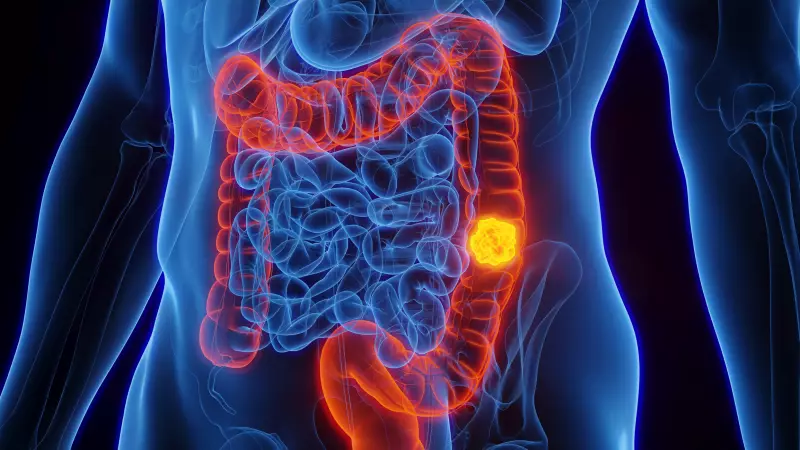 Câncer de intestino em jovens: um alerta global que você não pode ignorar