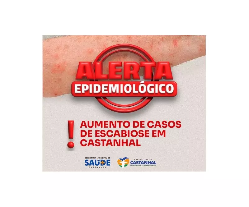 Castanhal em alerta: casos de sarna disparam e autoridades orientam como se proteger