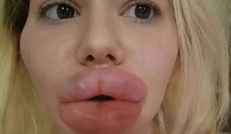 Excesso de preenchimento labial: riscos à saúde e impactos na estética