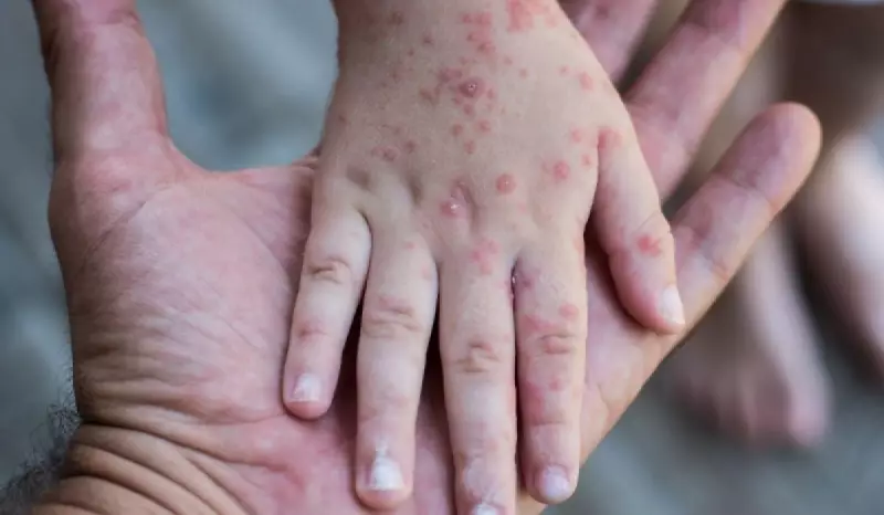 Febre aftosa em humanos: mito ou realidade? Entenda os riscos