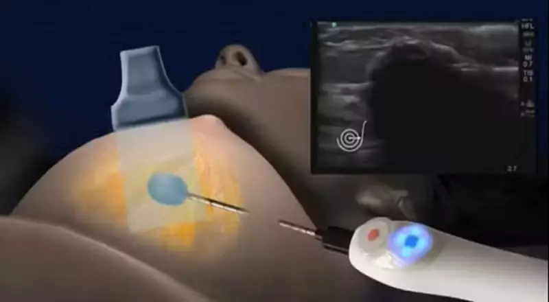 Hospital do Coração busca voluntárias para teste pioneiro contra câncer de mama que evita cirurgia