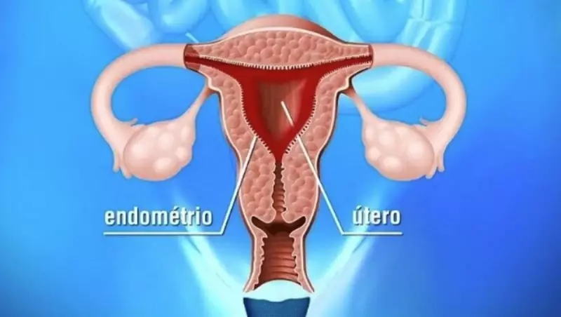 Limeira aprova programa pioneiro de atenção à saúde da mulher com endometriose