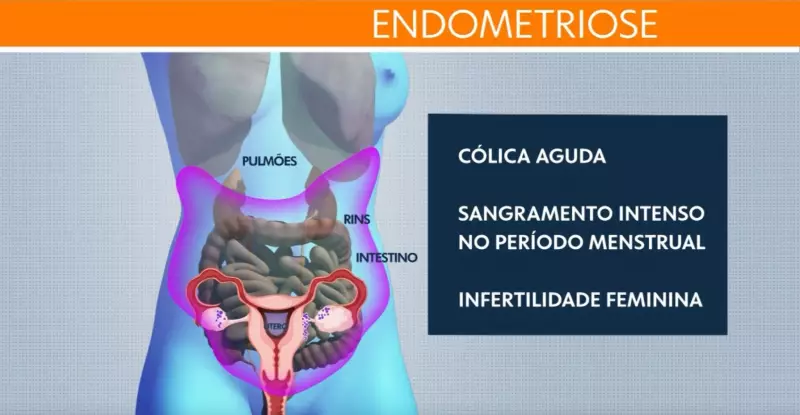 Limeira aprova programa pioneiro de proteção à mulher com endometriose: entenda os benefícios
