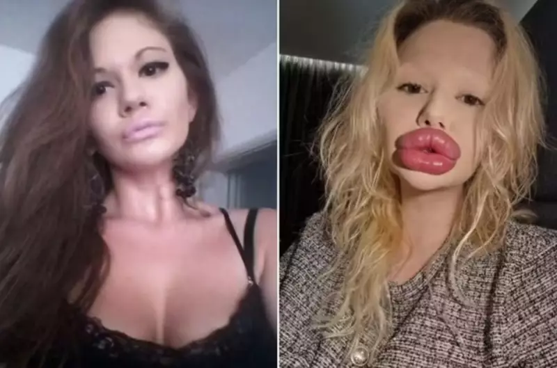 Mulher com os maiores lábios do mundo revela dificuldades: dentistas se recusam a atendê-la