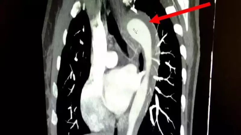 Mulher de 45 anos rompe aorta durante orgasmo e passa por cirurgia de emergência