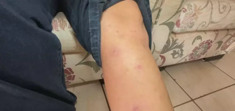 Queda nas temperaturas exige cuidados redobrados com a pele seca e dermatites