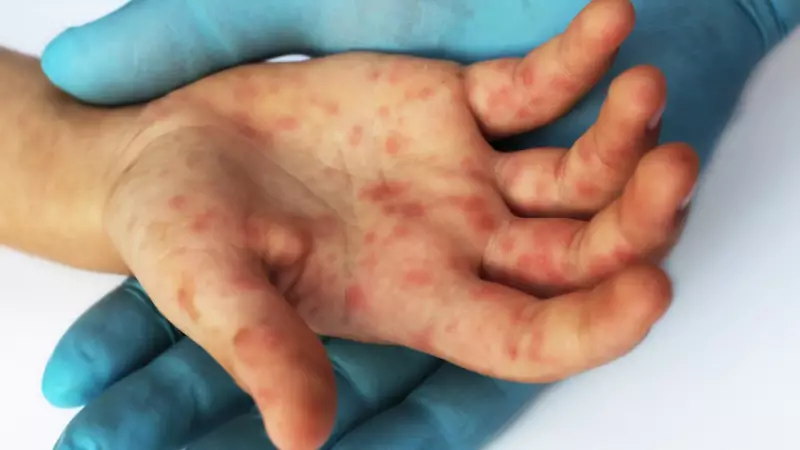 Surto de sarampo em Tocantins: seis casos confirmados acendem alerta sanitário