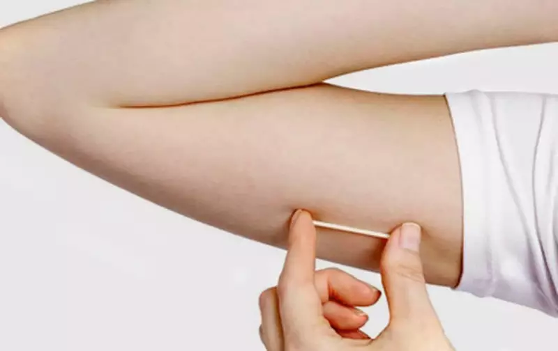 SUS incorpora implante contraceptivo de longa duração que custa até R$ 4 mil