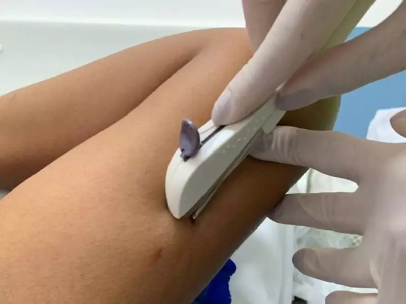 SUS passa a oferecer implante contraceptivo subdérmico: como funciona e quem pode usar