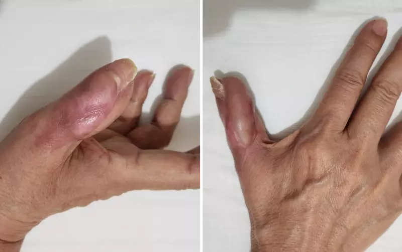 Unha mal feita vira pesadelo: mulher perde parte do dedo e enfrenta cirurgias e 70 sessões de fisioterapia