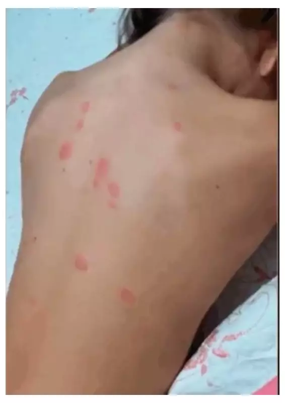 Alergia Misteriosa em Lucas do Rio Verde: Praça Interditada e Governo em Estado de Alerta
