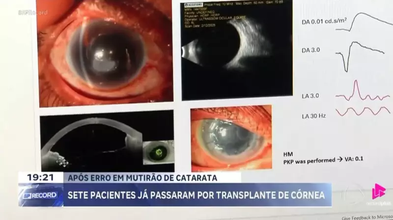 Erro em Mutirão de Catarata em SP: 7 Pacientes Submetidos a Transplante de Córnea Urgente